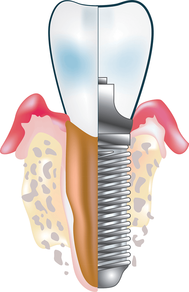 Zubni implanti - Dental implant expert