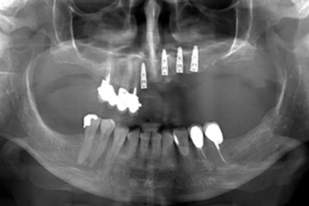 Poređenje vilične kosti pre i posle gubitka zuba Atrofija vilične kosti - Dental Implant Expert
