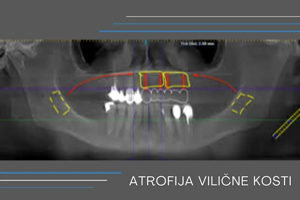 Atrofija vilične kosti - Dental Implant Expert