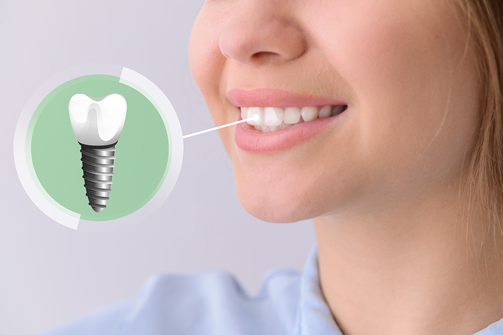 Oralna Implantologija - Poliklinika Dental Implant Expert