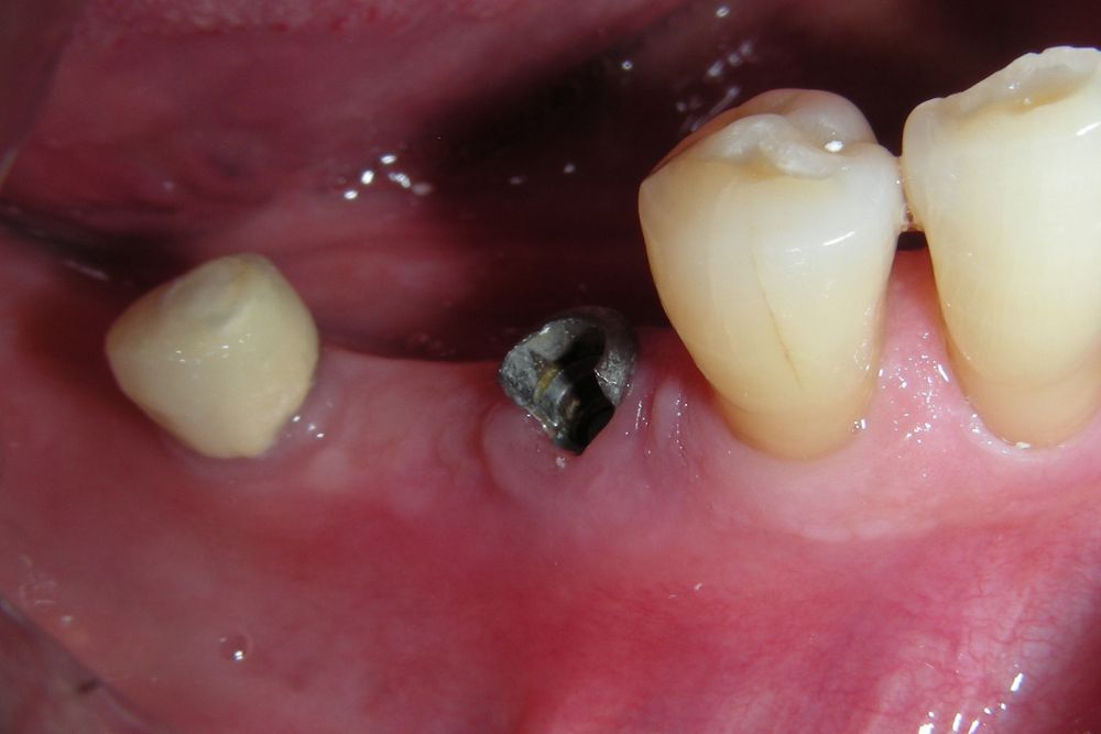 komplikacije sa zubnim implantima dental implant expert 3