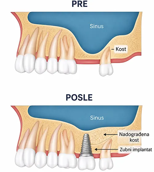 Kada je neophodan sinus lift
