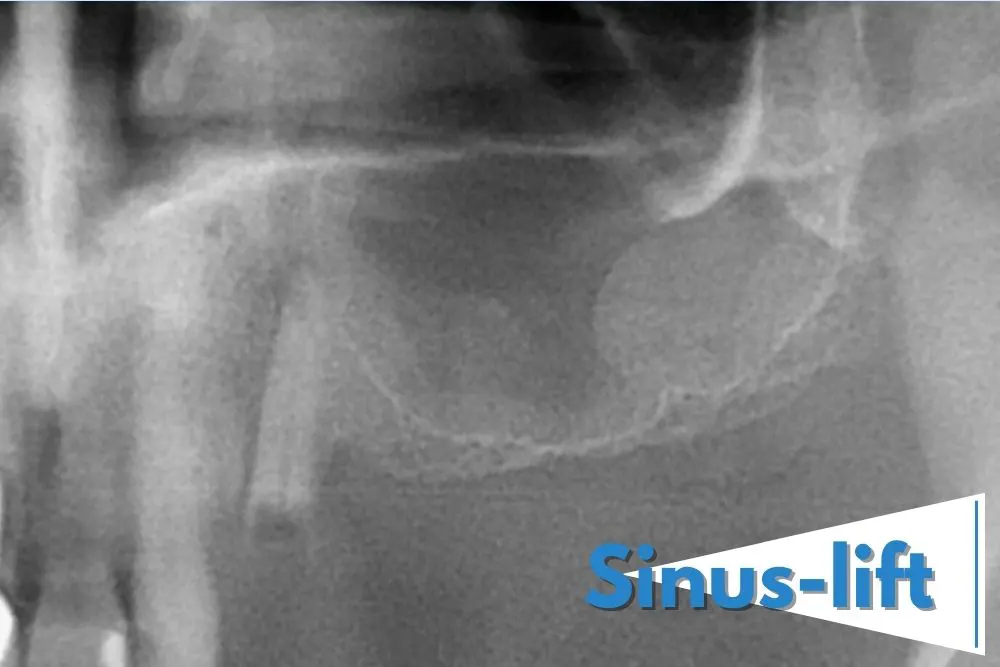 Nedostatak kosti ispod maksilarnog sinusa u gornjoj vilici - Kada je neophodan sinus lift