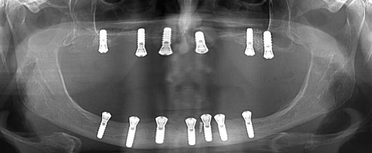 Cenovnik - Dental implant expert