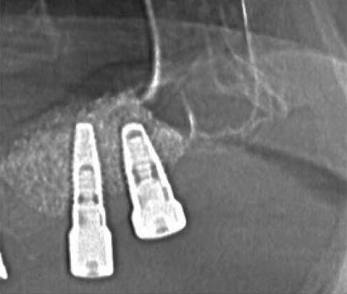 Cenovnik - Dental implant expert
