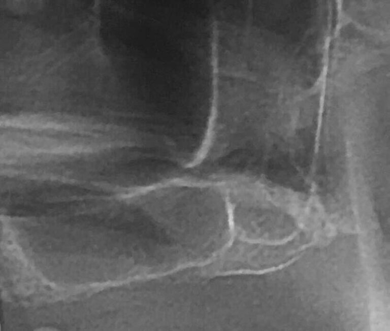 Debljina kosti ispod sinusa 1 mm