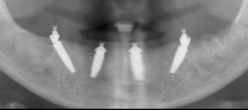Cena ALL on 4 zubni implanti