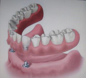 Cena zubnih implanta - Dental implant expert