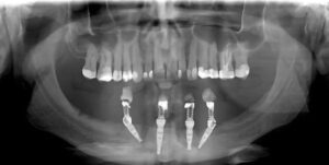 Ugrađena 4 implanta - Dental implant expert