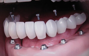 All on 6 cena - Dental implant expert