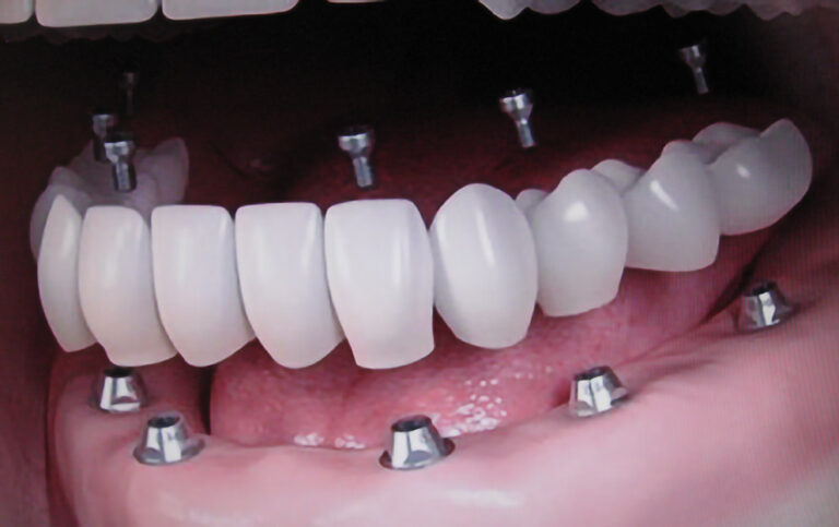 Cena zubnih implanta - Dental implant expert