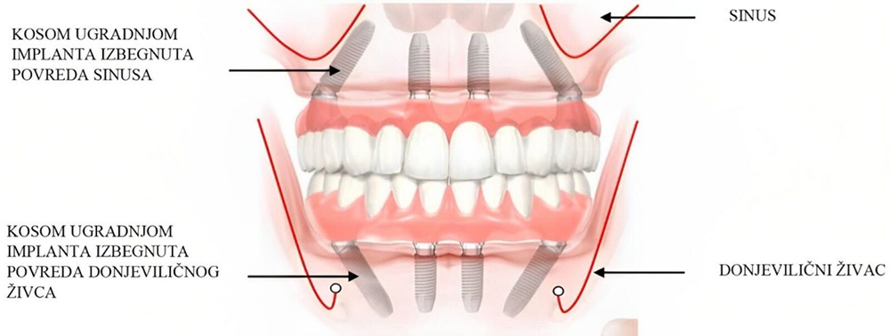 Zubni implanti all on 4 metoda