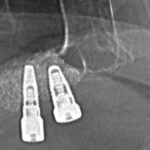 Implanti - Sinus lift i ugrađeni implanti