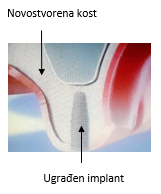Sinus lift - Ugradnja implanta