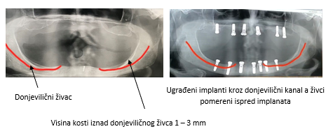 Implanti - Blizina donjoviličnog živca