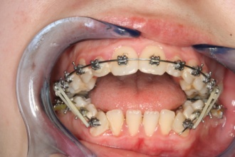 Ispravljanje zuba pomocu fiksne proteze