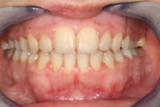 Hollywood smile - Izgled zuba posle hirurške intervencije