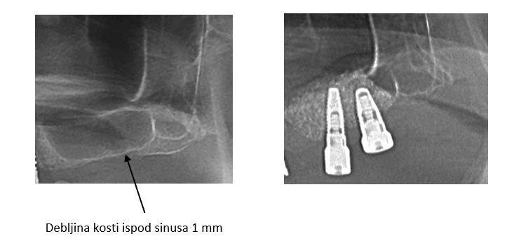 Sinus lift metoda uradjena na kosti debljine ispod sinusa 1mm