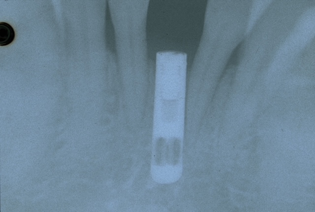 Rengenski snimak postvaljenog implanta