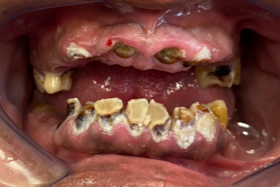 Zubi puni karijesa i velikig plombi