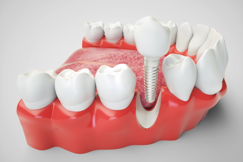 Ugradnja imapalata Dental Implant Expert