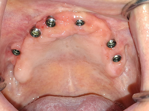 Izgled ugrađenih implanata u ustima posle transplatacije kosti