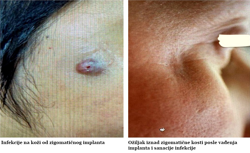 Komplikacije zigomatičnih implanata - Komplikacije zigomatičnih implanata - Ožiljak iznad zigomatične kosti posle vađenja implanta i sanacije infekcije