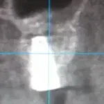 Izvađena cista iz sinusa dodata veštačka kost i ugrađen implant