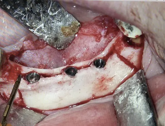 Ugradnja implanata kada nema dovoljno vilične kosti - Širenje uske vilične kosti piezo metodom