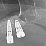 Ugradnja implanata kada nema dovoljno vilične kosti - Sinus lift