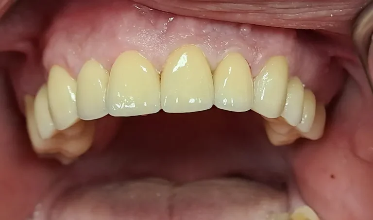 Krunice na priprodnim zubima