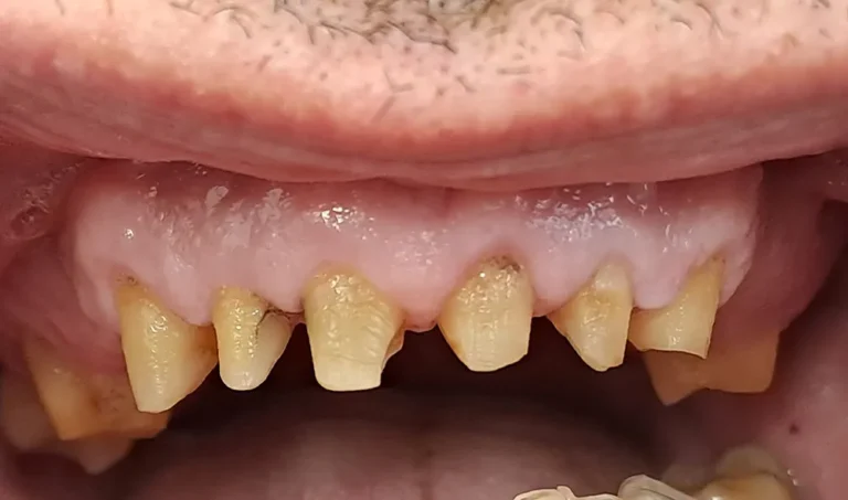 Krunice na priprodnim zubima