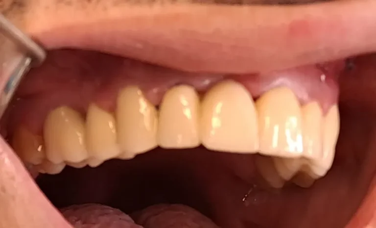 Krunice na prirodnim zubima