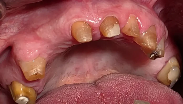 Krunice na prirodnim zubima