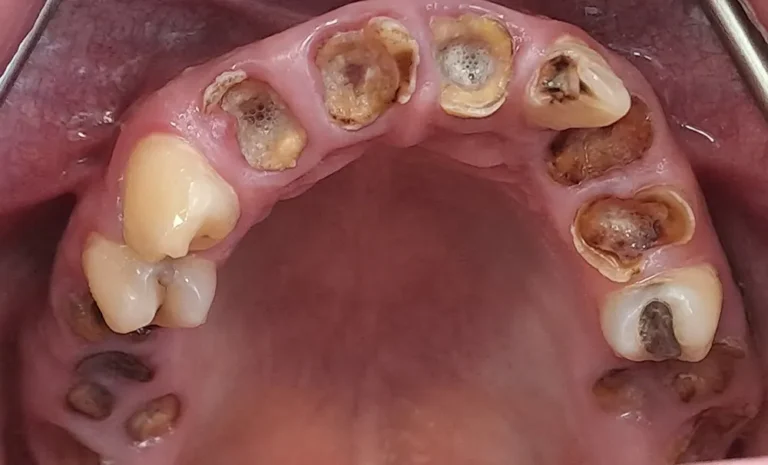 Krunice na prirodnim zubima