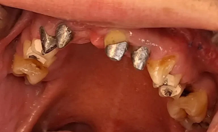 Krunice na prirodnim zubima