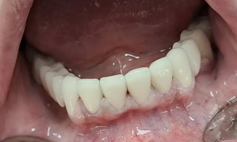 Dental implant expert Pacijent posle