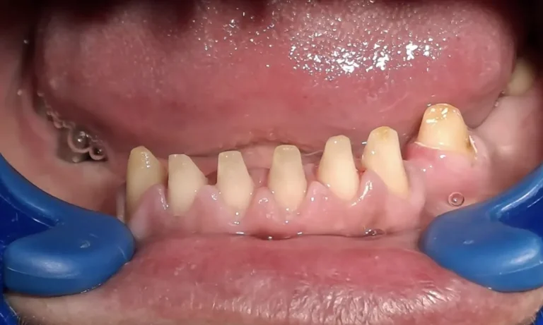Dental implant expert Pacijent pre