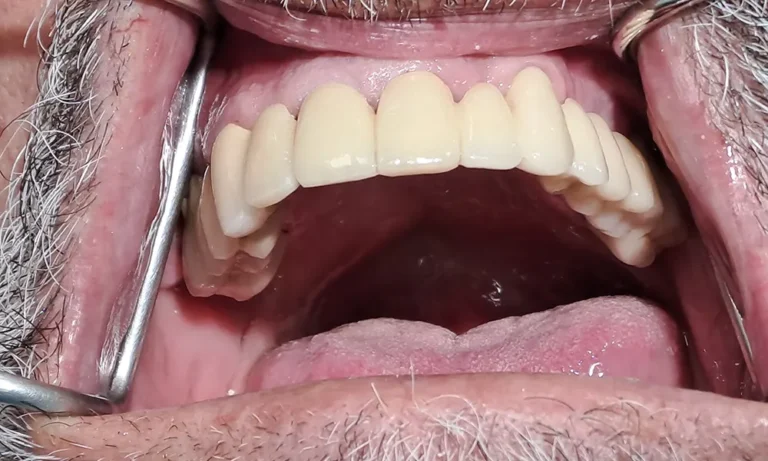 Galerija Pacijent Posle - Dental implant expert