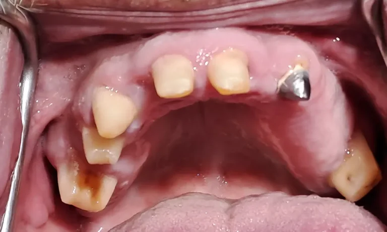 Galerija Pacijent Pre - Dental implant expert