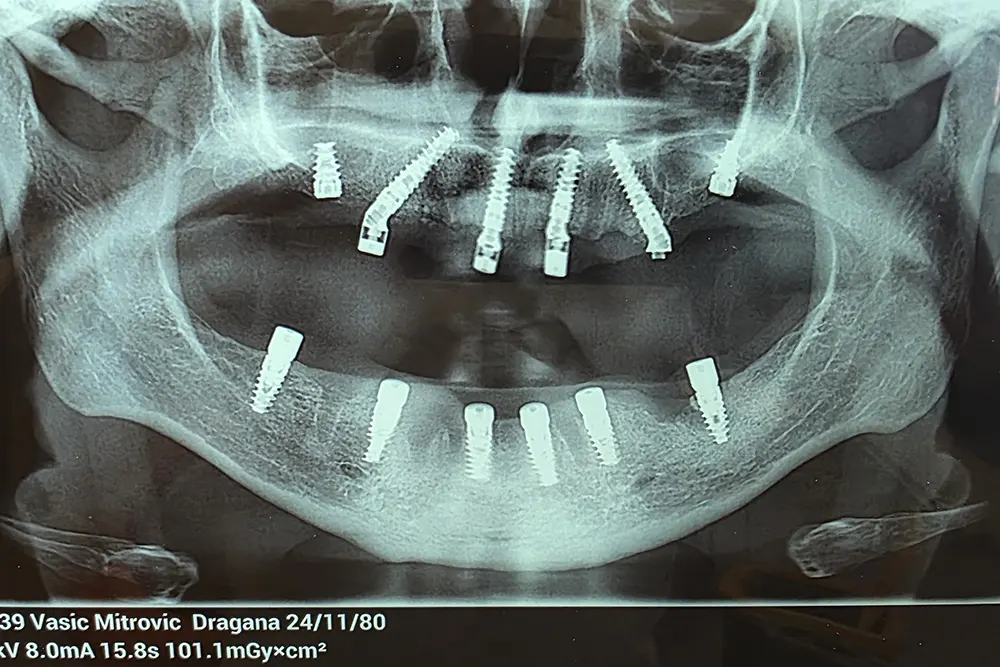 Ugradnja zubnih implantata - Moguće komplikacije, uzroci i kako ih sprečiti