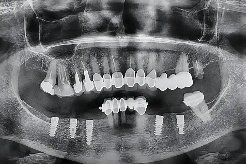 Ugradnja zubnih implantata moguće komplikacije