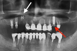 Panoramski rendgen snimak implantata sa strelicama koje označavaju mehaničke komplikacije – slomljen deo implanta i odvrnut protetski šraf