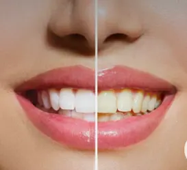 Hollywood smile - Izbeljivanje zuba