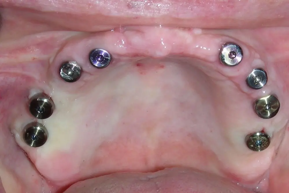 16 dentalnih implantata 8 implantata po vilici totalna bezubost