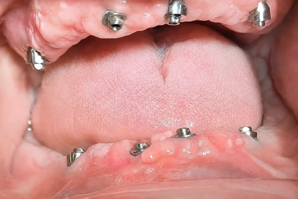 All on 4 cetiri implanta po vilici posle ugradnje implantata