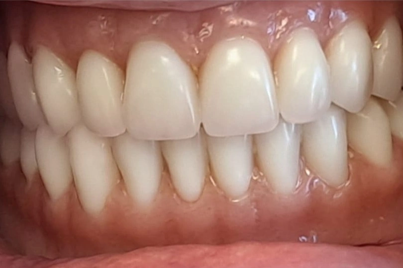 All on 4 fiksni zubi na cetiri implantata konacan rezultat
