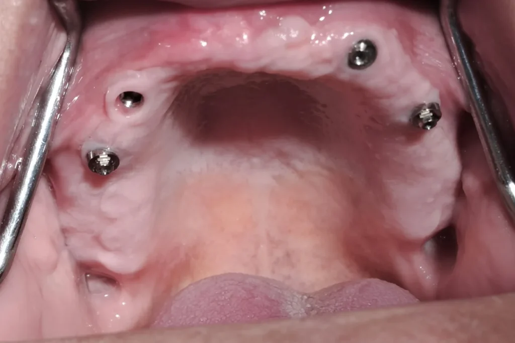 Fiksni zubi na 4 implantata bez sinus lifta