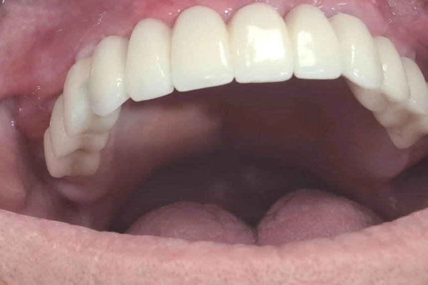 Fiksni zubi na 4 implantata bez sinus lifta