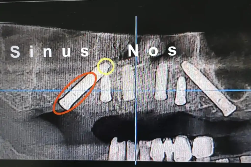 Implant prosao kroz sinus i nosni hodnik ct snimak